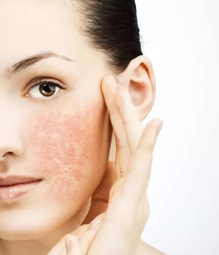 敏感性皮肤照片